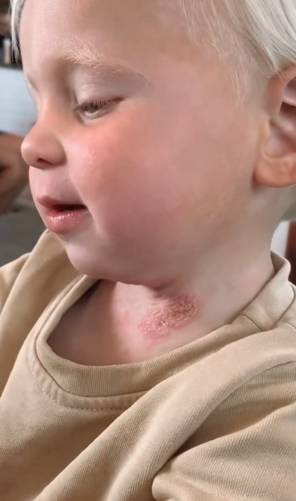 Eczema