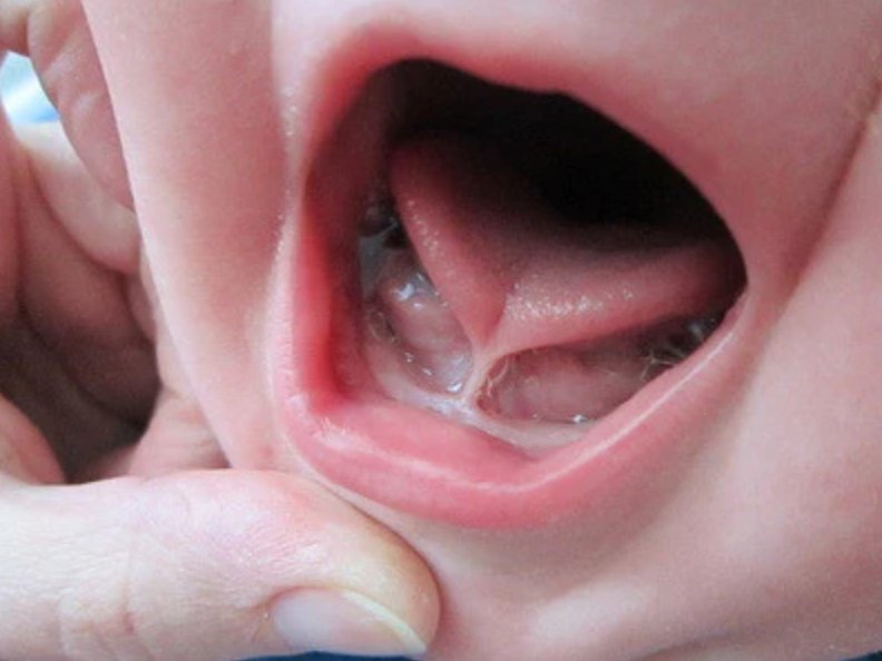 Tongue Ties